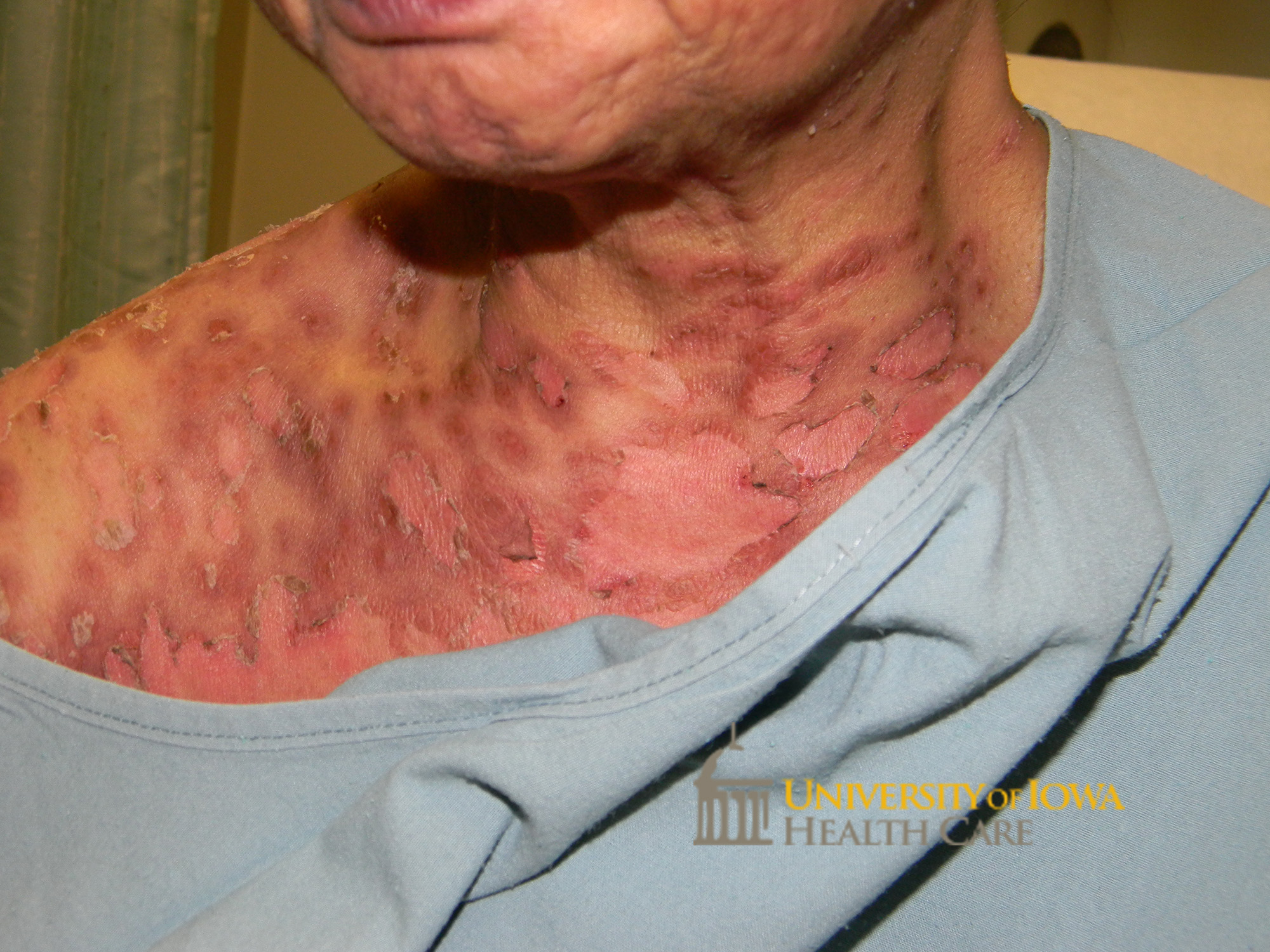 Superficial erosions and flacid bullae with surrounding erythema. (click images for higher resolution).